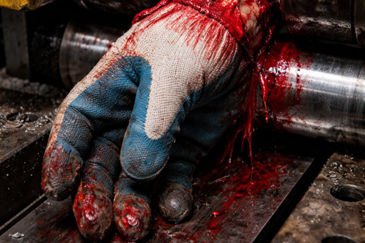 ​Workplace Injuries in Manufacturing: Understanding and Preventing Degloving, Amputations